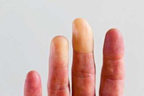 acrosyndrome raynaud angiologue béziers