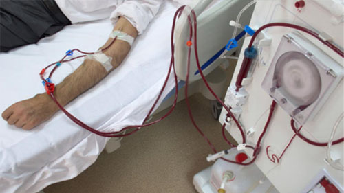 fistule hémodialyse angiologue béziers